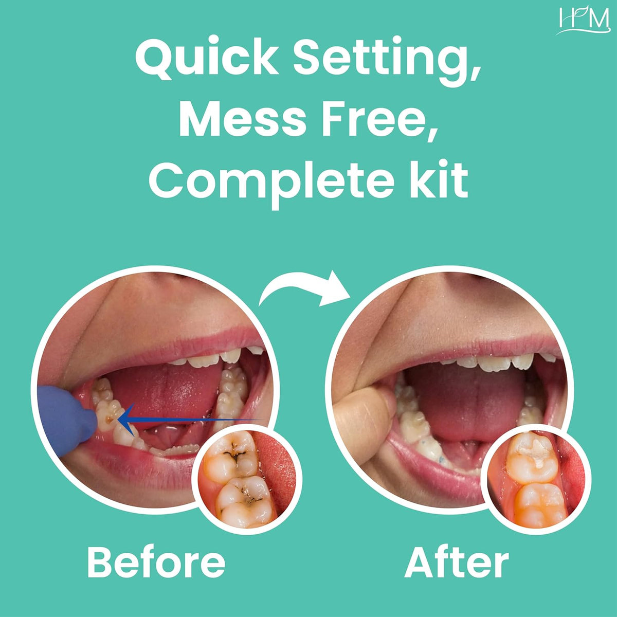 Dental filling kit