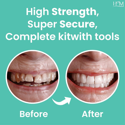 Dental filling kit